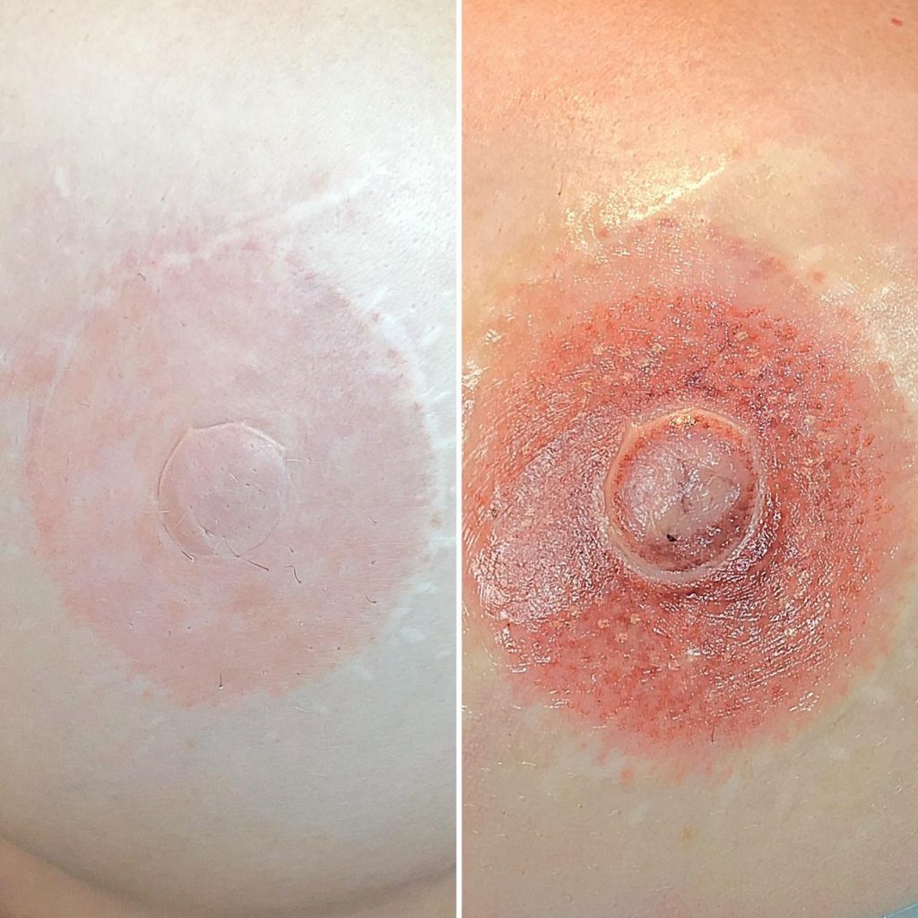 Areola Simulation Training
